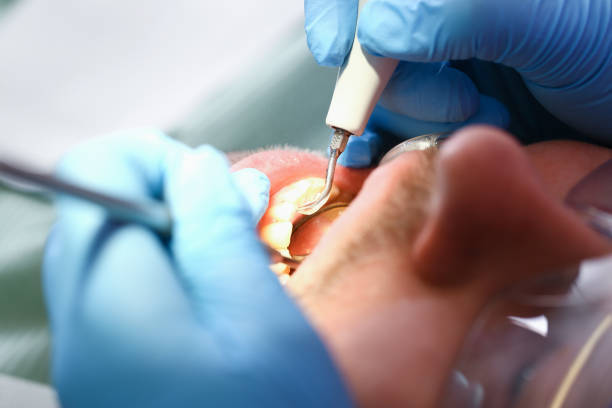 Best Emergency Dental Care for Sports Injuries in Red Bank, SC