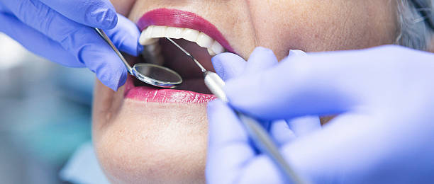 Best Emergency Wisdom Tooth Extraction in Red Bank, SC